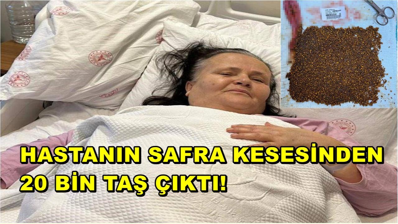 Hastanın Safra Kesesinden 20 Bin Taş Çıktı!