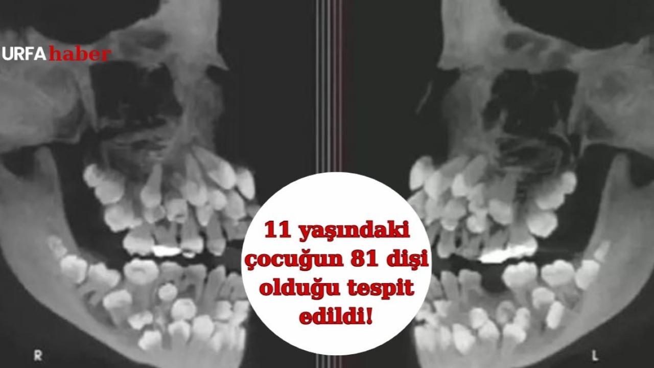 11 yaşındaki çocuğun 81 dişi olduğu tespit edildi!