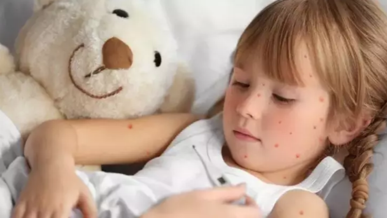 Okullarda Suçiçeği Vakaları Artıyor: Bu Belirtilere Dikkat