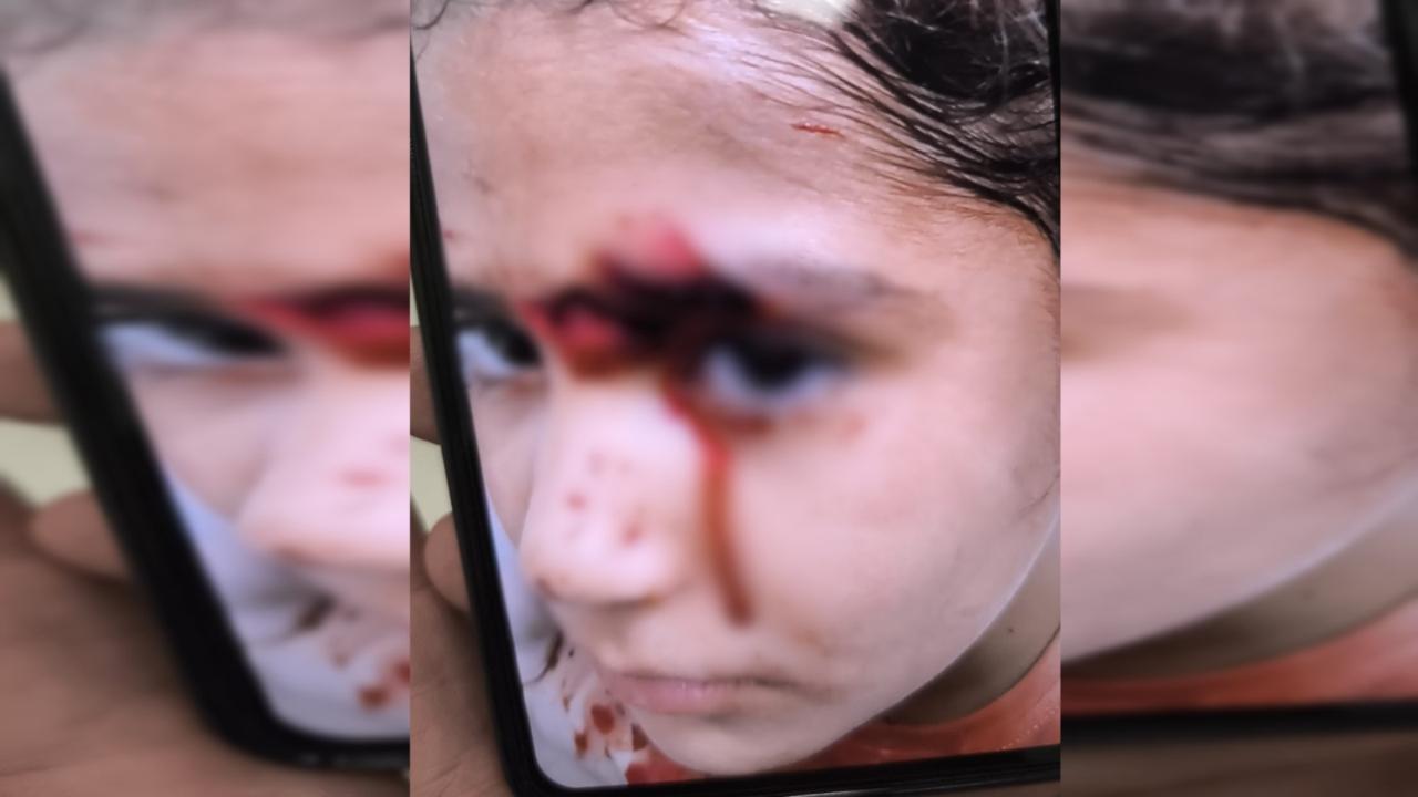 Urfa'da köpek saldırısına uğrayan Hevin için Fidan'dan tepki!