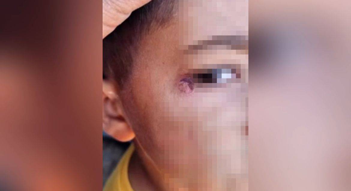 Şanlıurfa’da Öğrencinin Yüzünde Sigara Söndürüldü