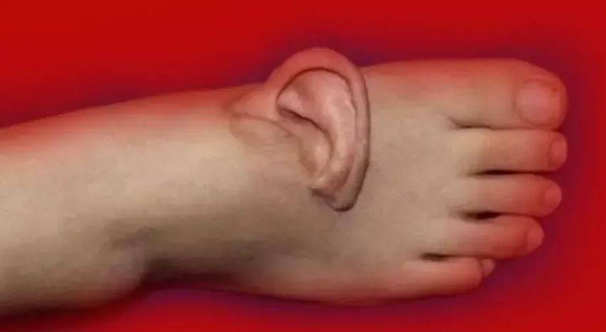 Böyle Olay Yaşanmadı...Kulağını Tam 5 Ay Ayağında Taşıdı!